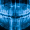 Teeth X-Ray