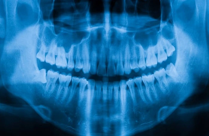 Teeth X-Ray